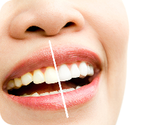 Teeth Whitening